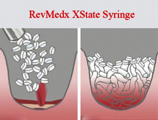 RevMedx XState Syringe