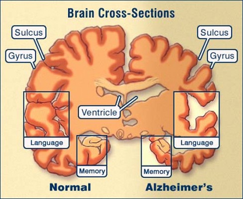 Alzheimer and Dementia